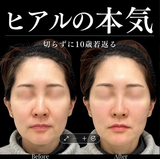 ヒアルロン酸の症例写真