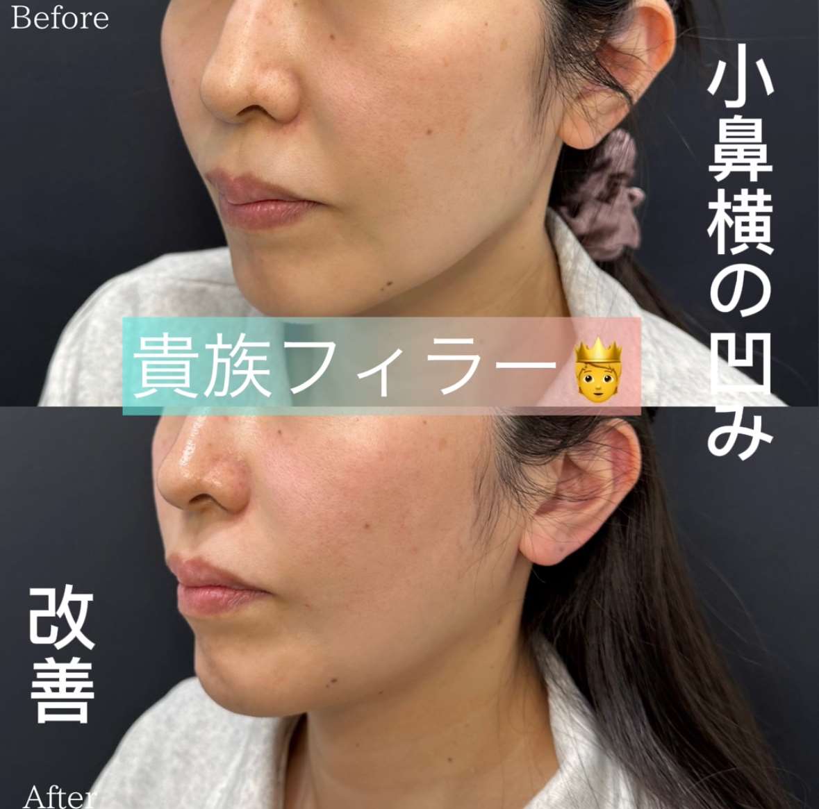 ヒアルロン酸の症例写真