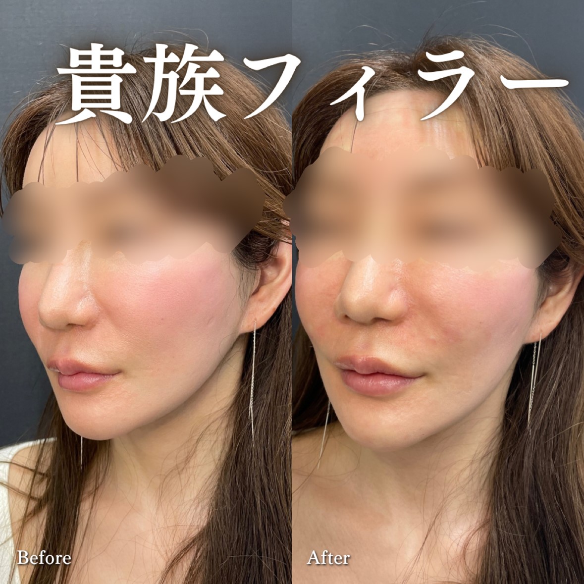 ヒアルロン酸の症例写真
