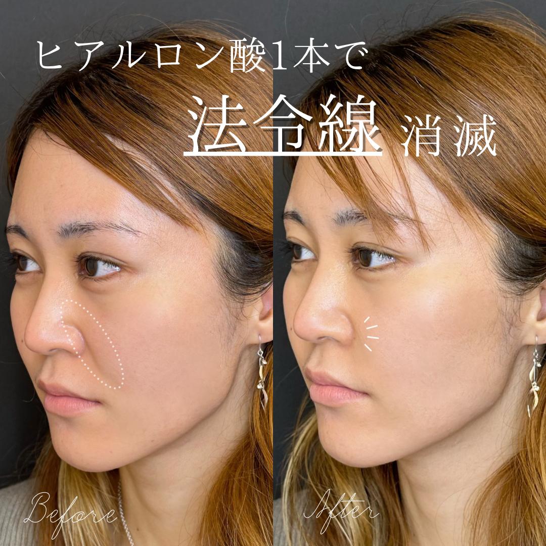 ヒアルロン酸の症例写真