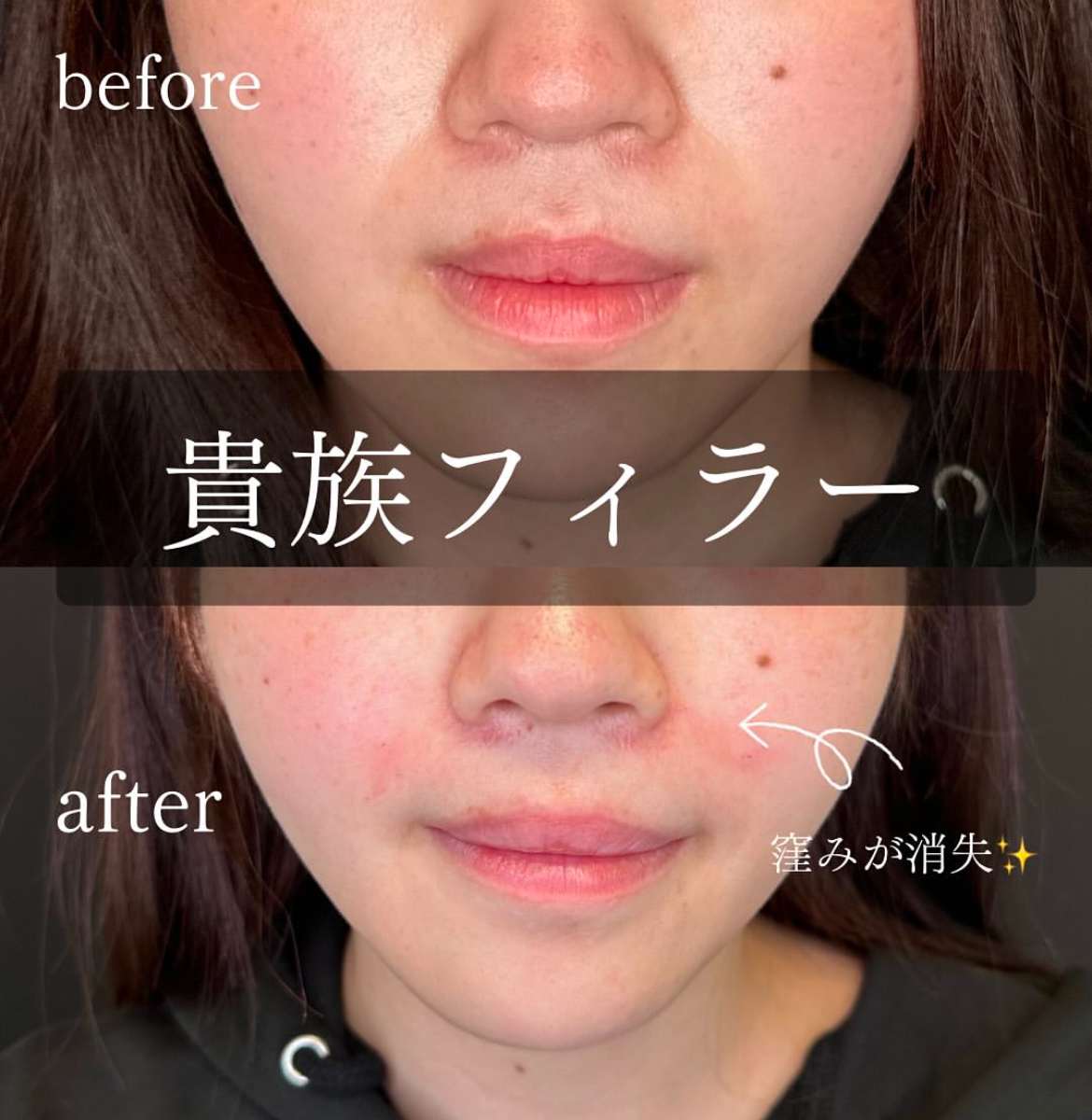 ヒアルロン酸の症例写真