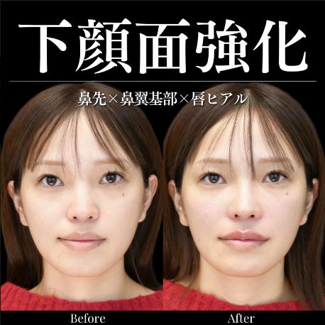 ヒアルロン酸の症例写真