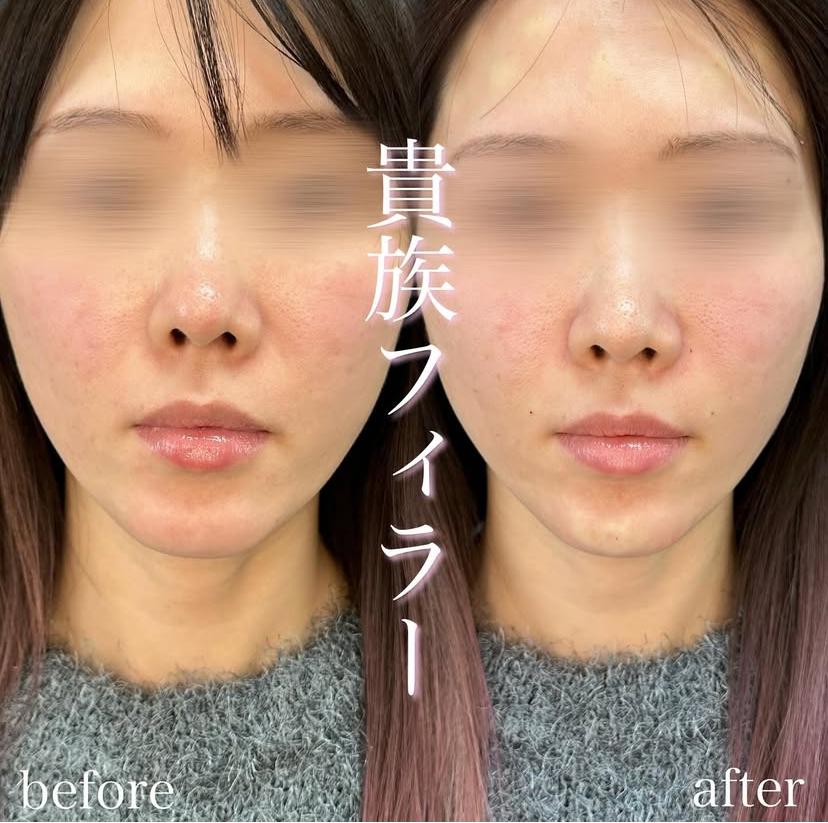 ヒアルロン酸の症例写真