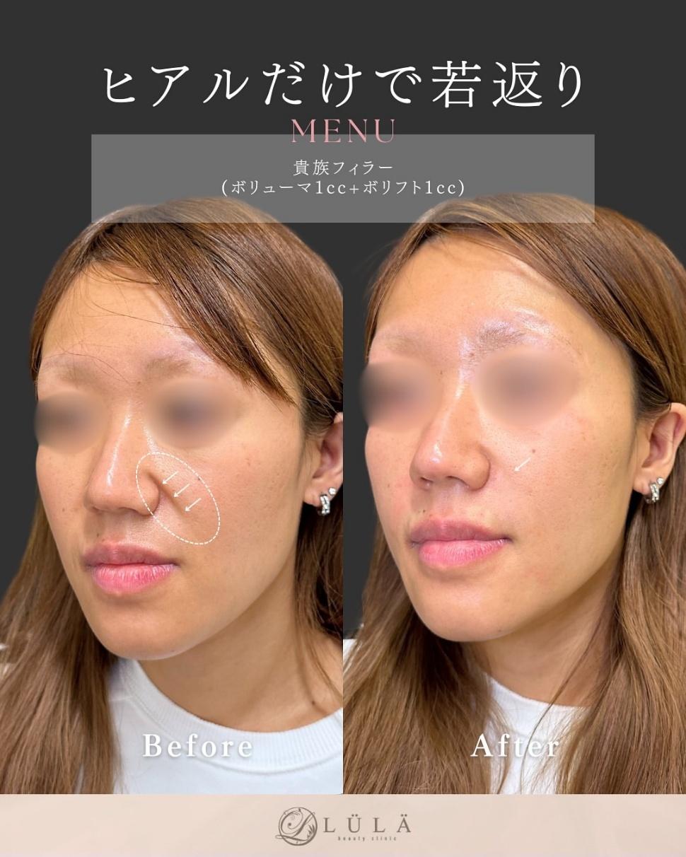 ヒアルロン酸の症例写真