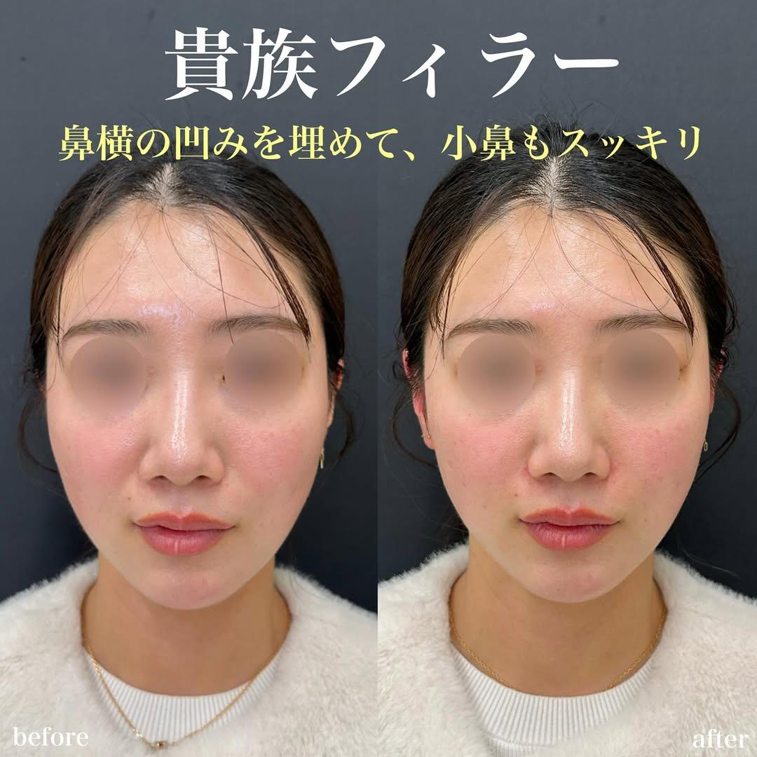 ヒアルロン酸の症例写真