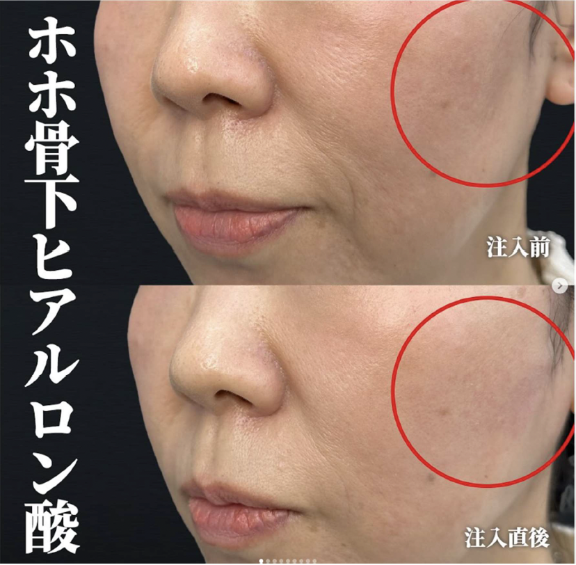 ヒアルロン酸の症例写真
