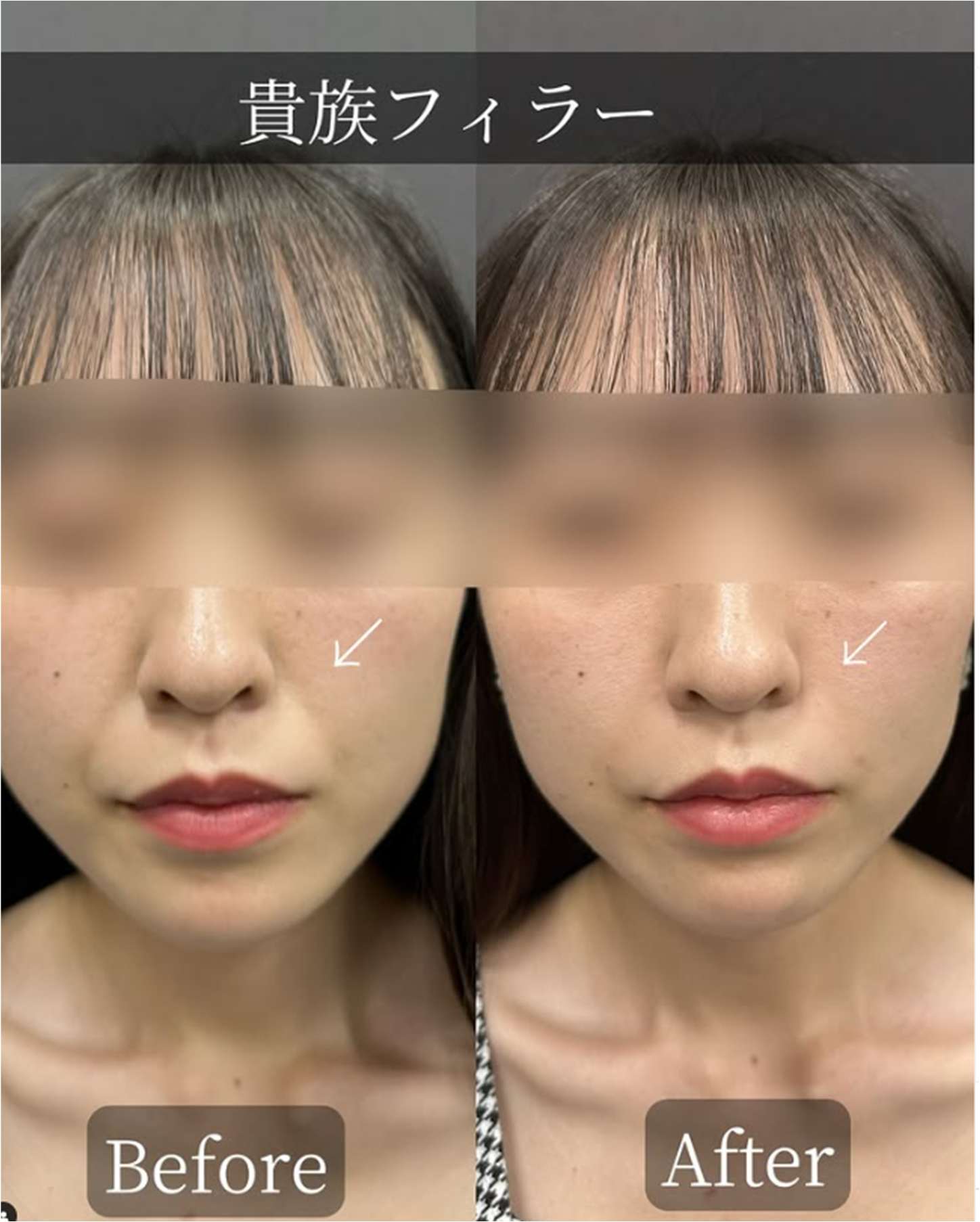 ヒアルロン酸の症例写真