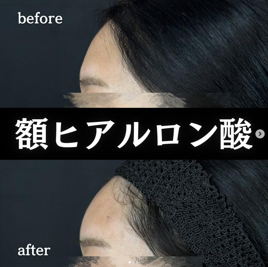 ヒアルロン酸の症例写真