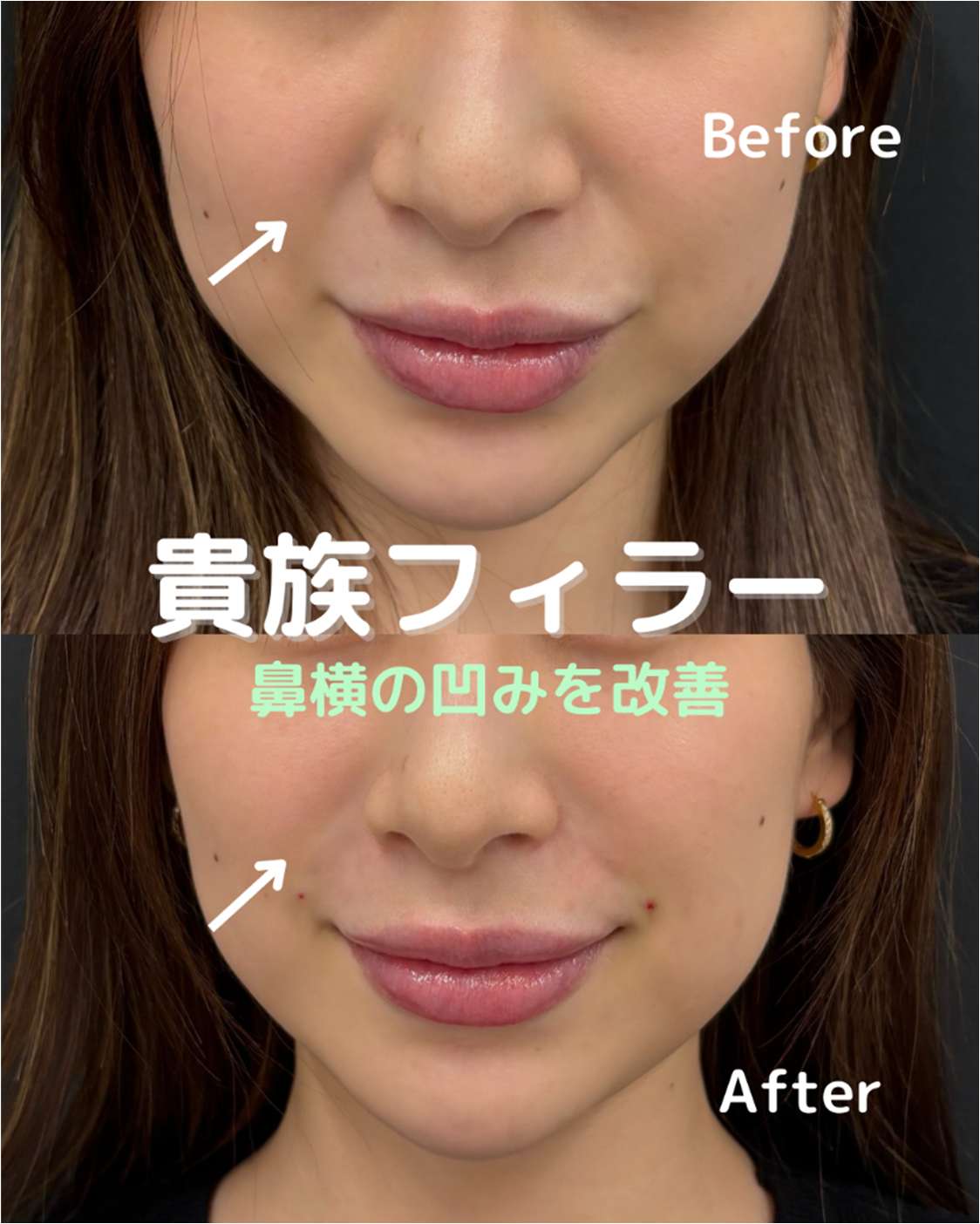 ヒアルロン酸の症例写真
