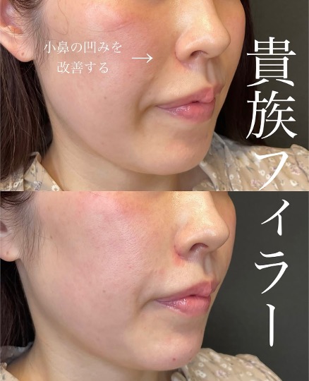 ヒアルロン酸の症例写真