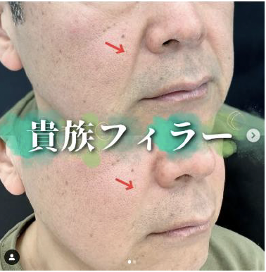 ヒアルロン酸の症例写真