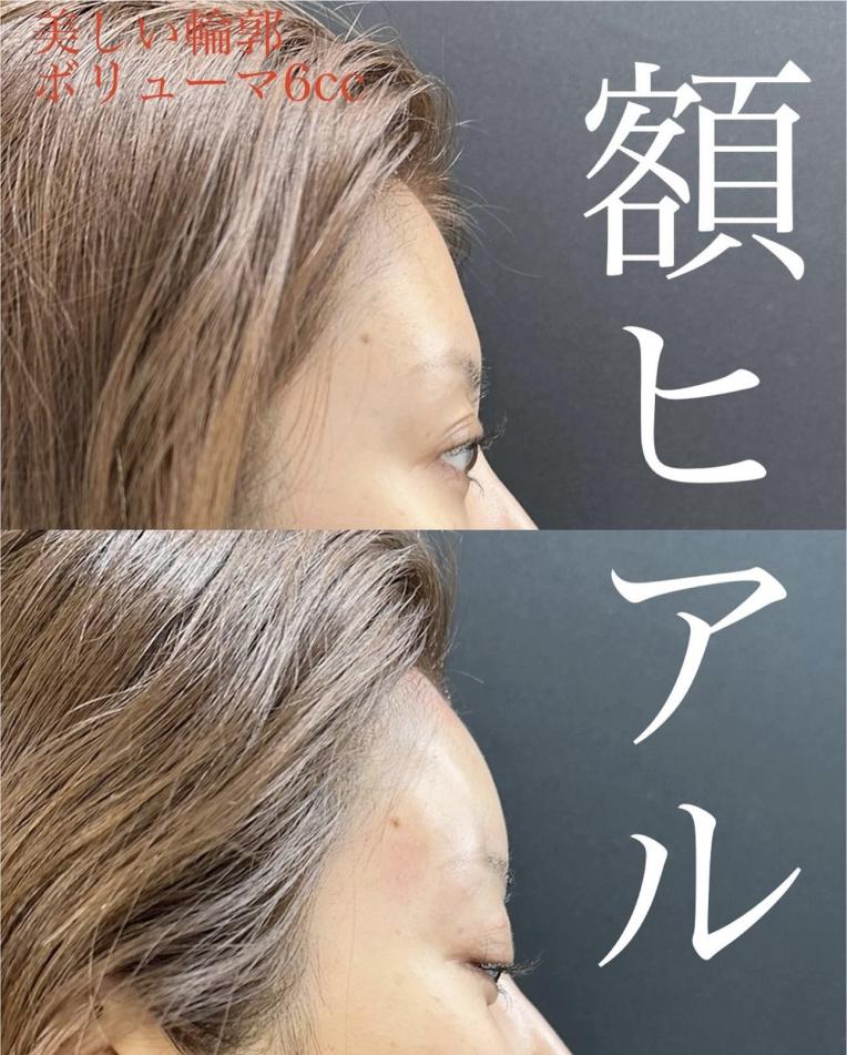 ヒアルロン酸の症例写真