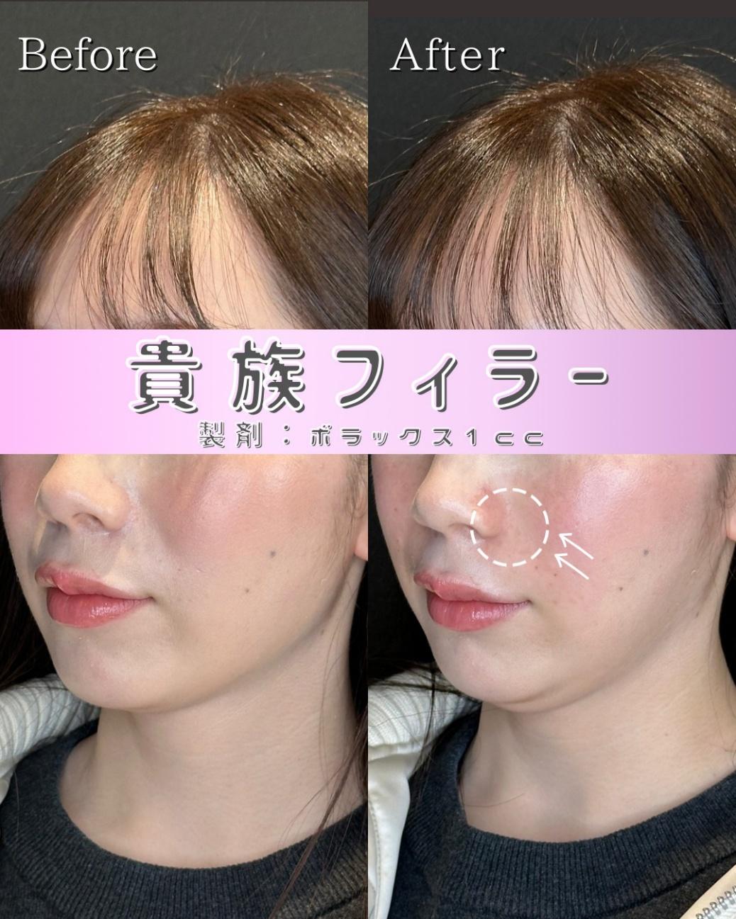 ヒアルロン酸の症例写真