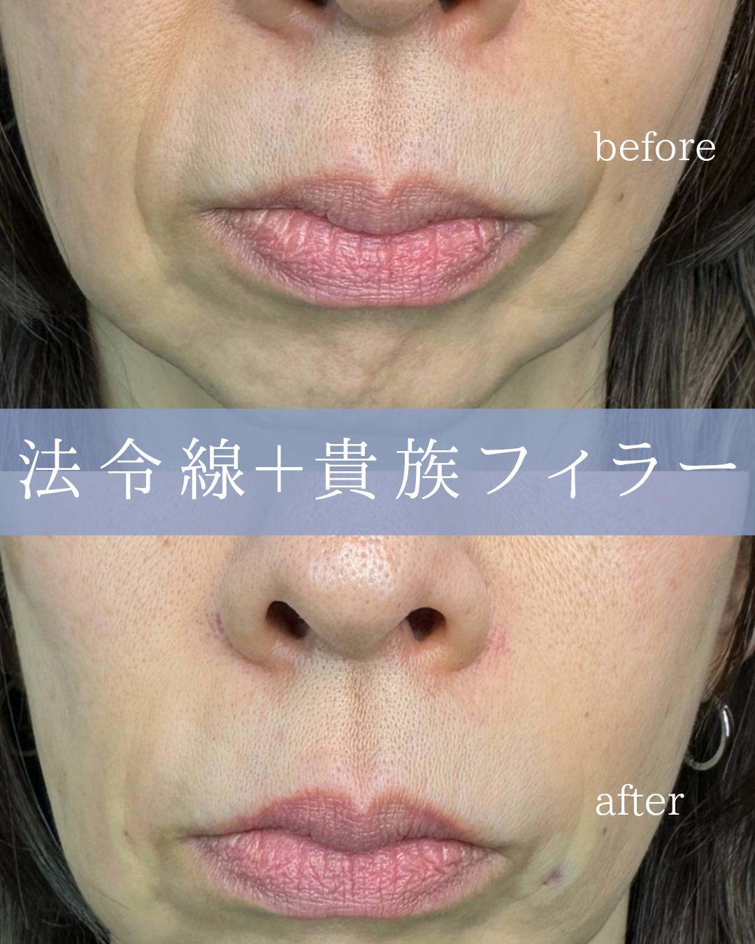 ヒアルロン酸の症例写真