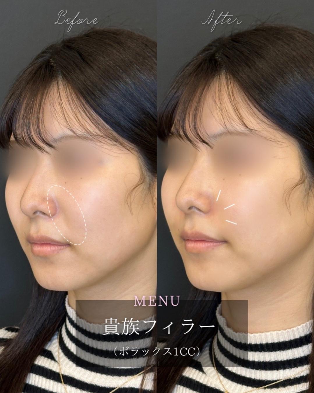 ヒアルロン酸の症例写真