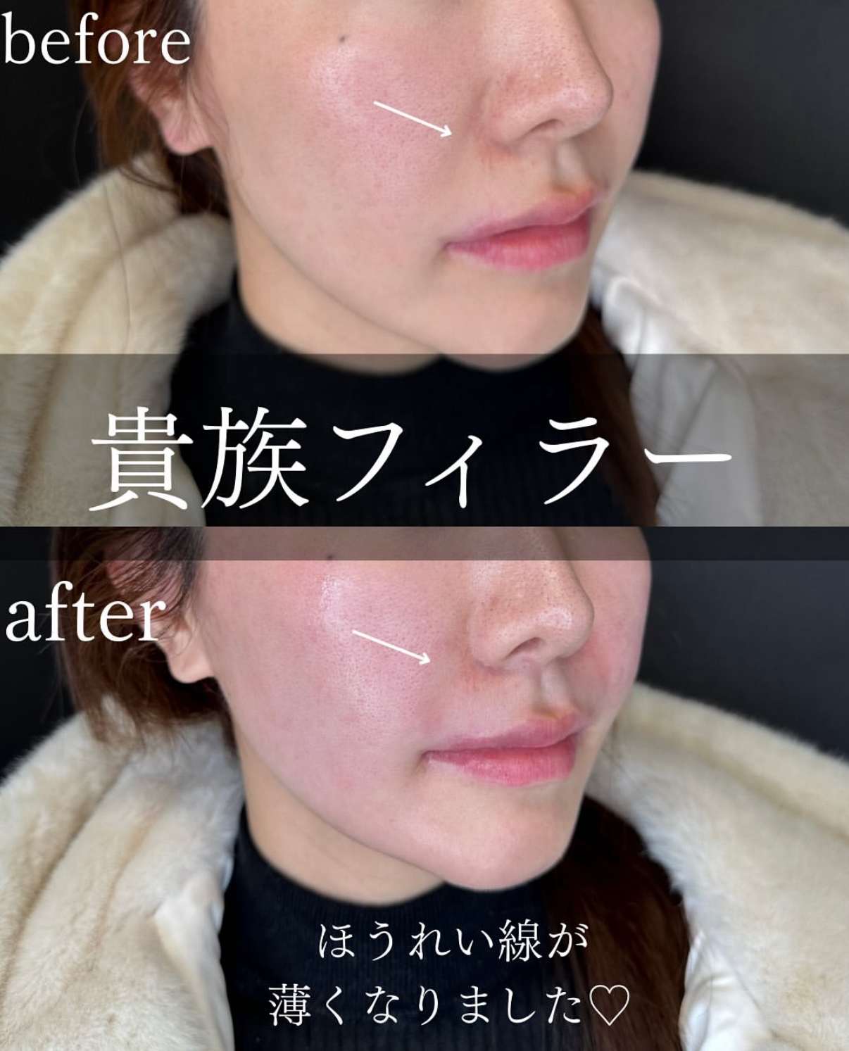 ヒアルロン酸の症例写真