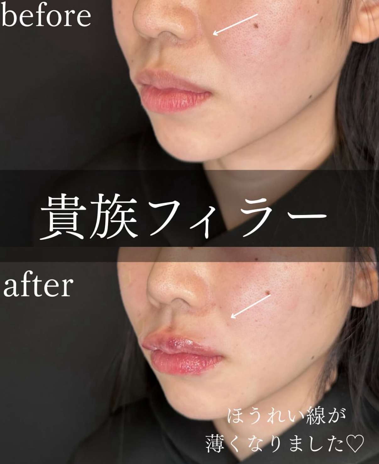 ヒアルロン酸の症例写真