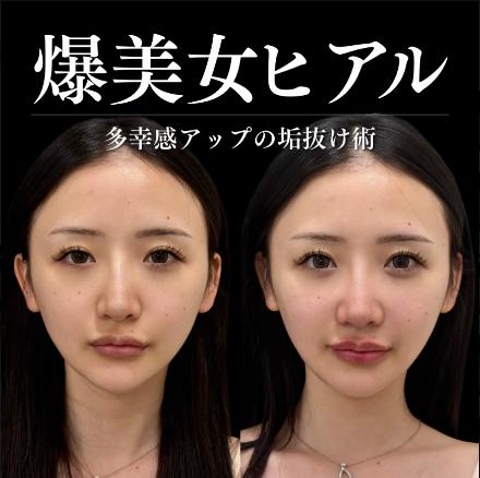 ヒアルロン酸の症例写真