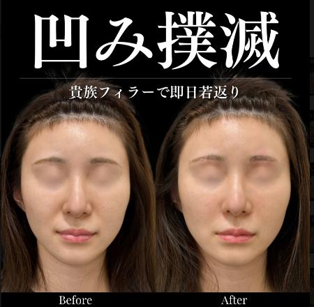 ヒアルロン酸の症例写真