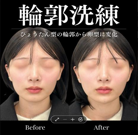 ヒアルロン酸の症例写真