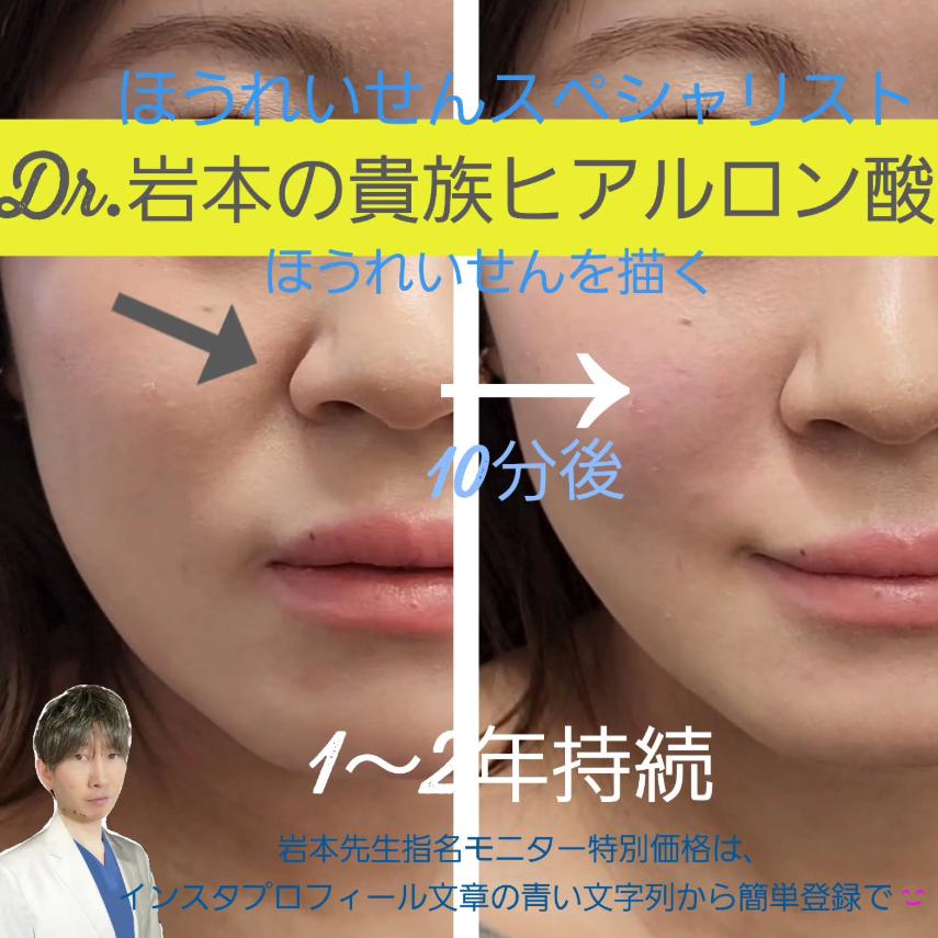 ヒアルロン酸の症例写真