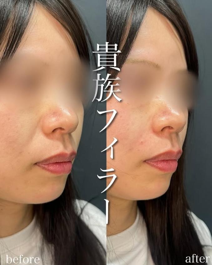 ヒアルロン酸の症例写真