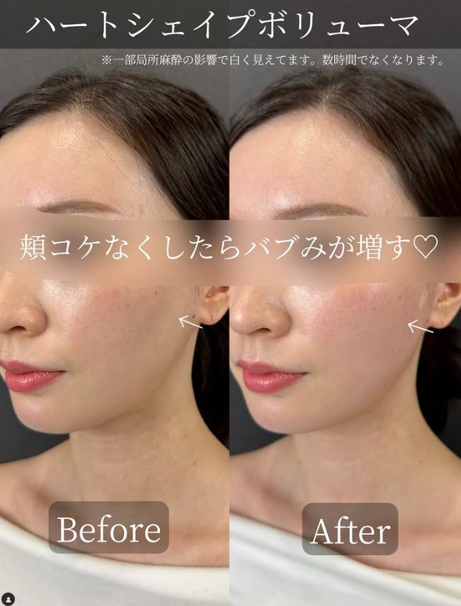 ヒアルロン酸の症例写真