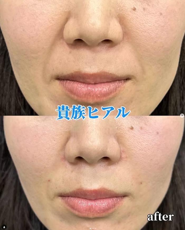 ヒアルロン酸の症例写真