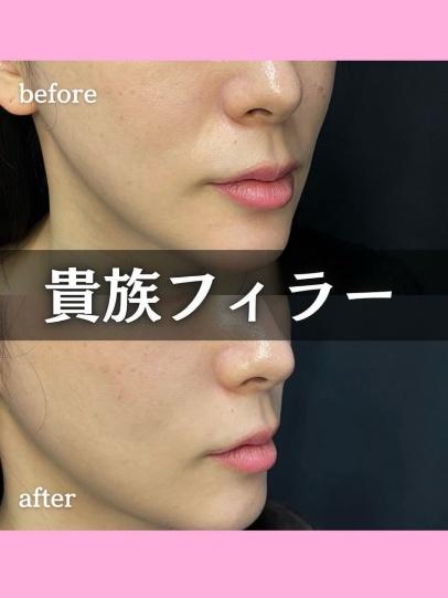ヒアルロン酸の症例写真