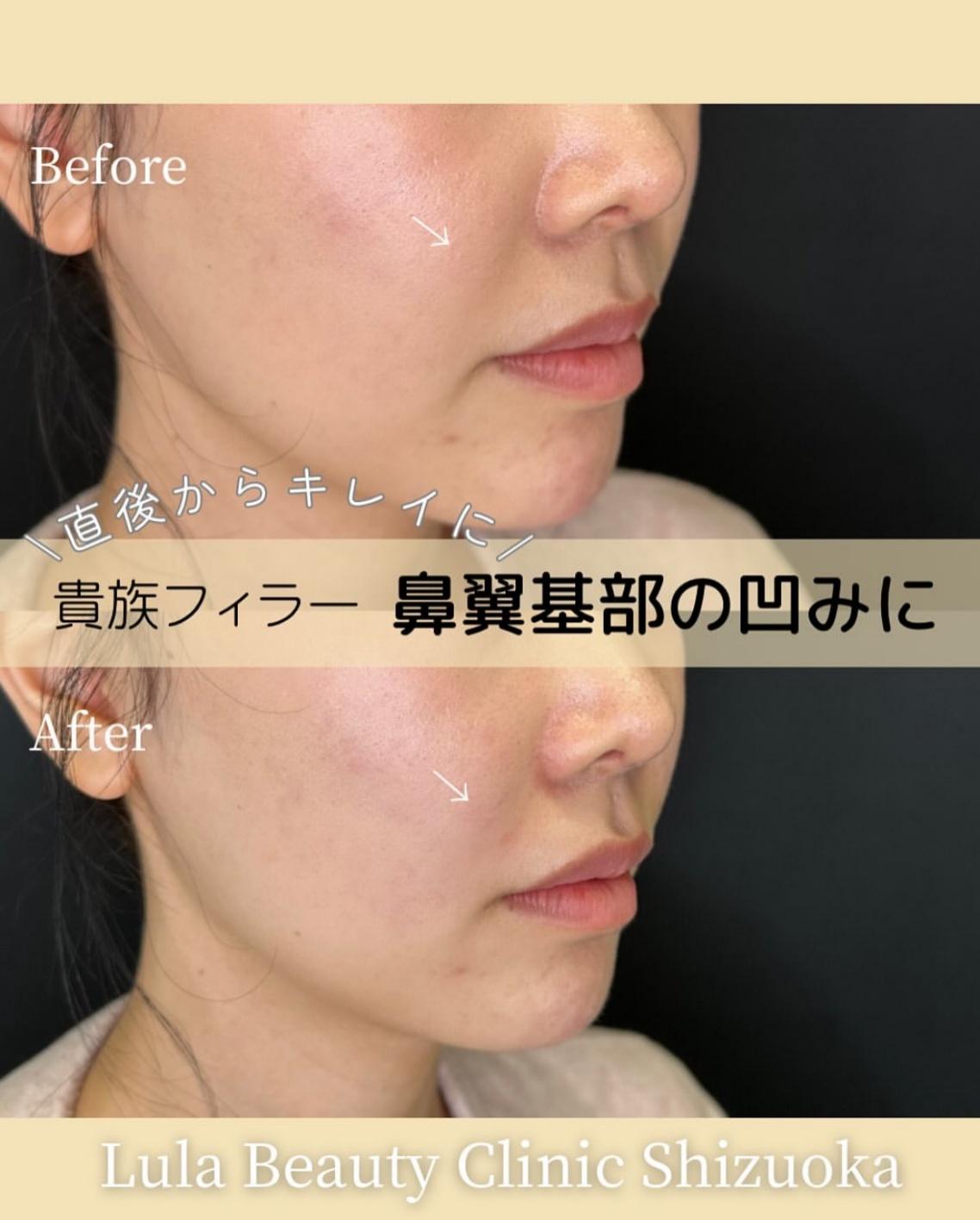 ヒアルロン酸の症例写真