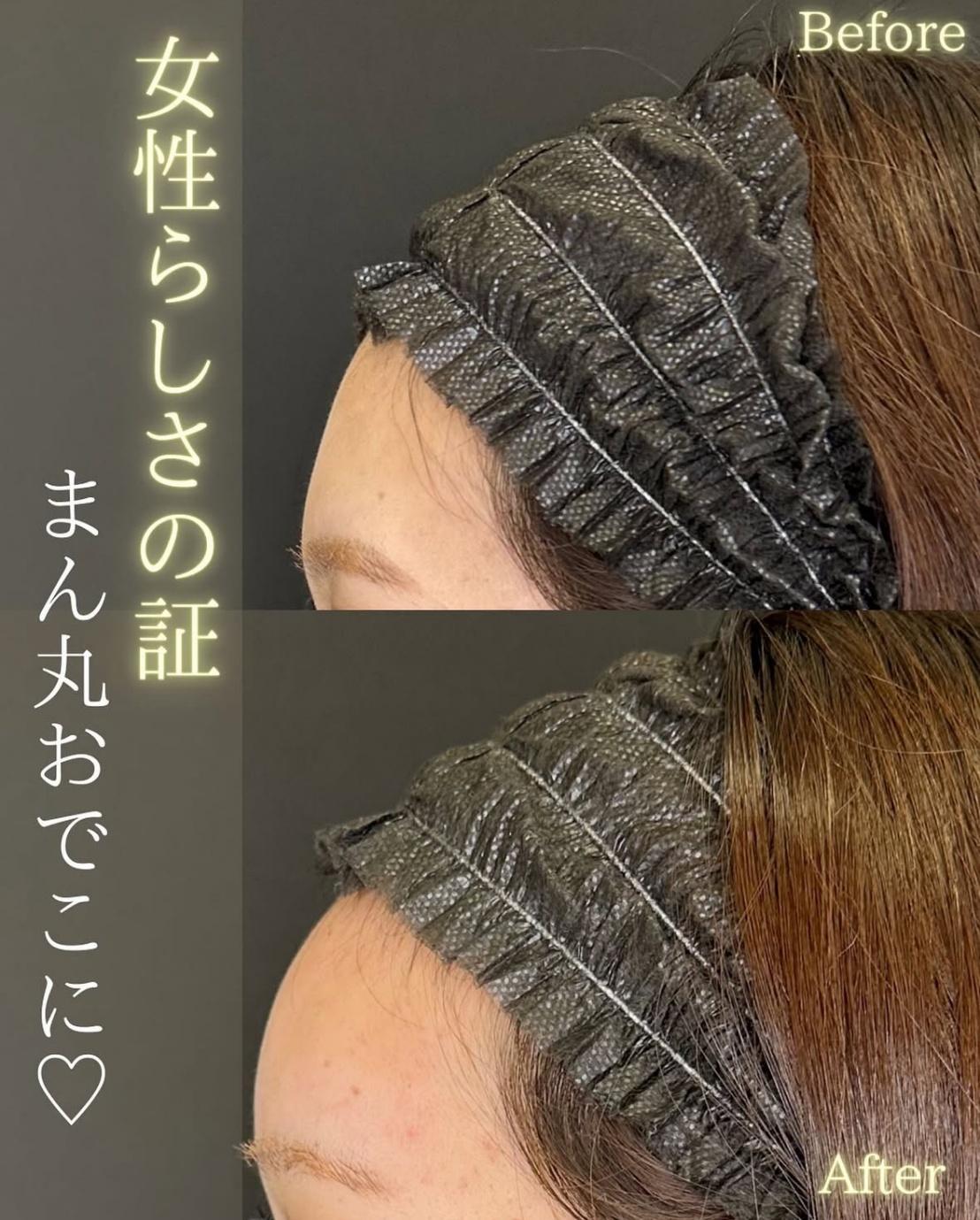 ヒアルロン酸の症例写真