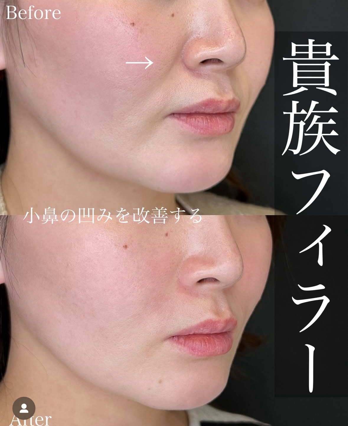 ヒアルロン酸の症例写真