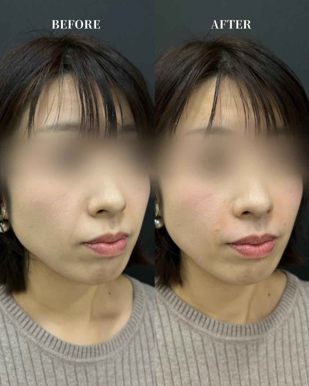 ヒアルロン酸の症例写真