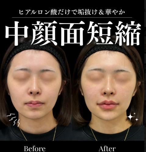 ヒアルロン酸の症例写真