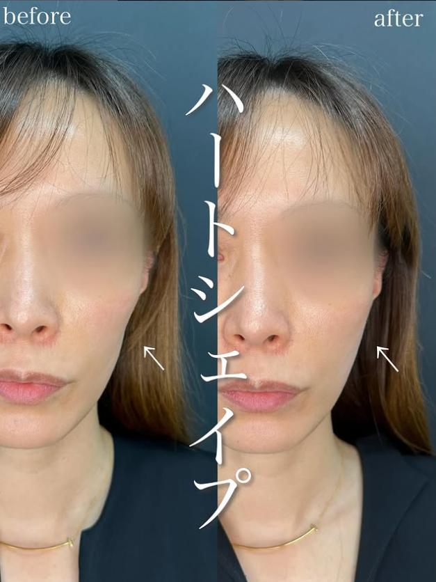 ヒアルロン酸の症例写真