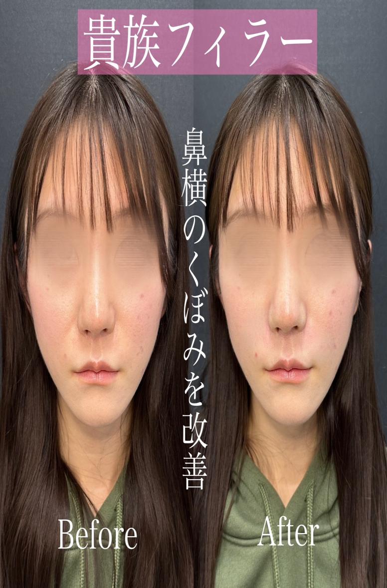 ヒアルロン酸の症例写真