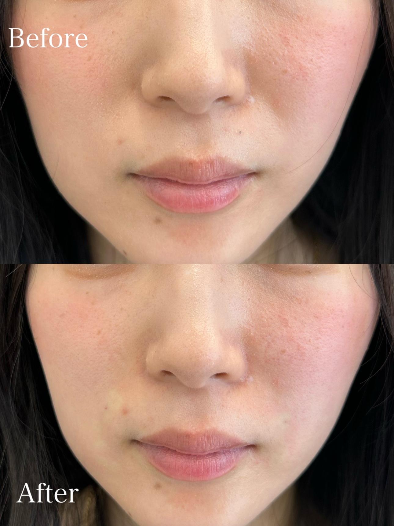 ヒアルロン酸の症例写真