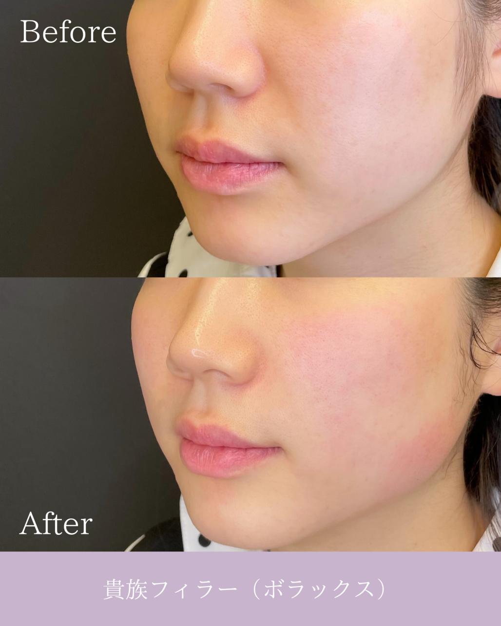 ヒアルロン酸の症例写真