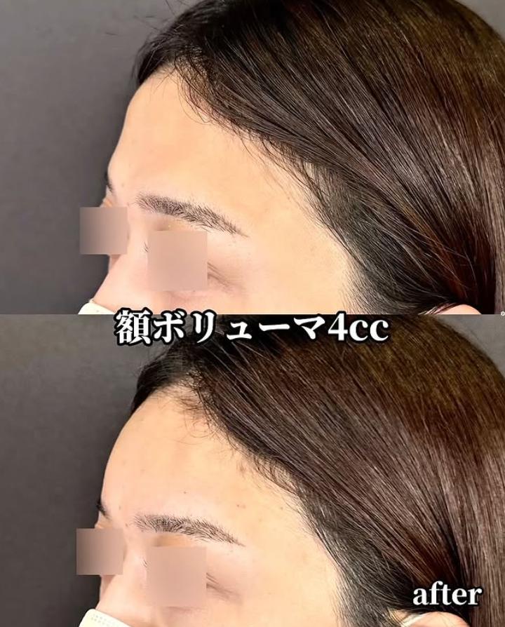 ヒアルロン酸の症例写真