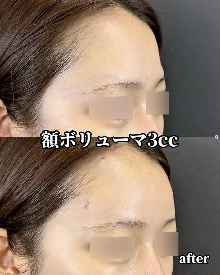 ヒアルロン酸の症例写真