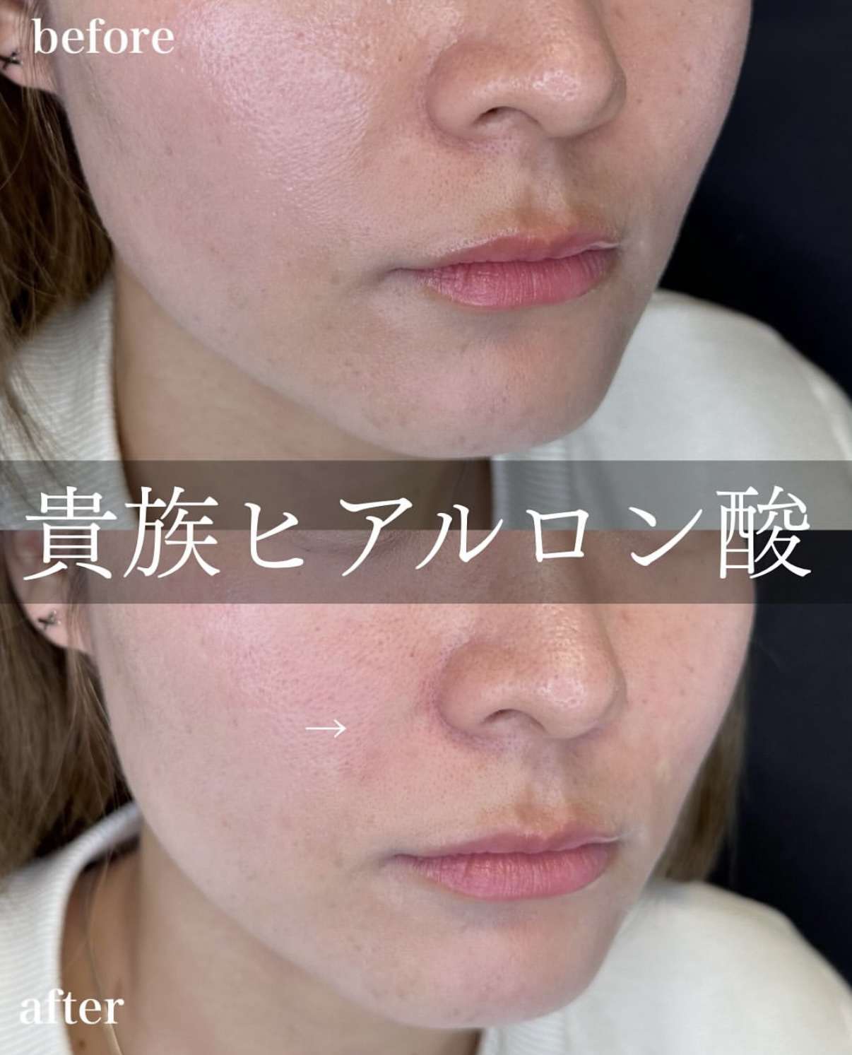 ヒアルロン酸の症例写真