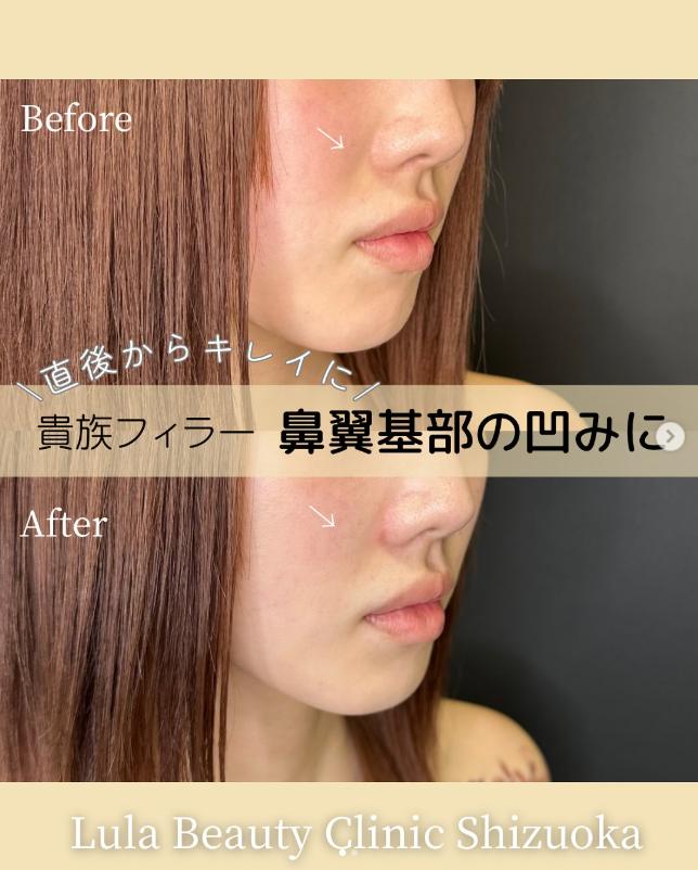 ヒアルロン酸の症例写真