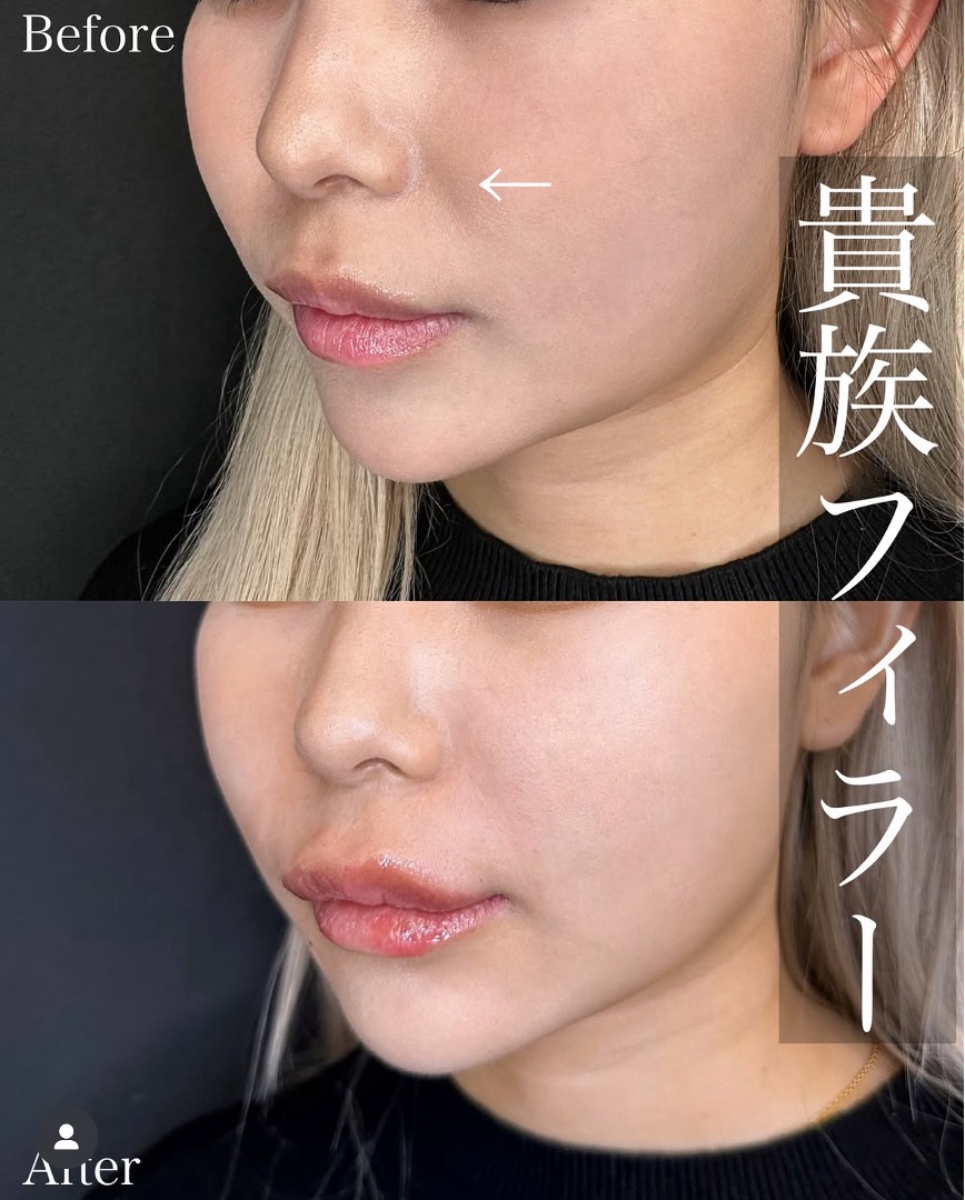 ヒアルロン酸の症例写真