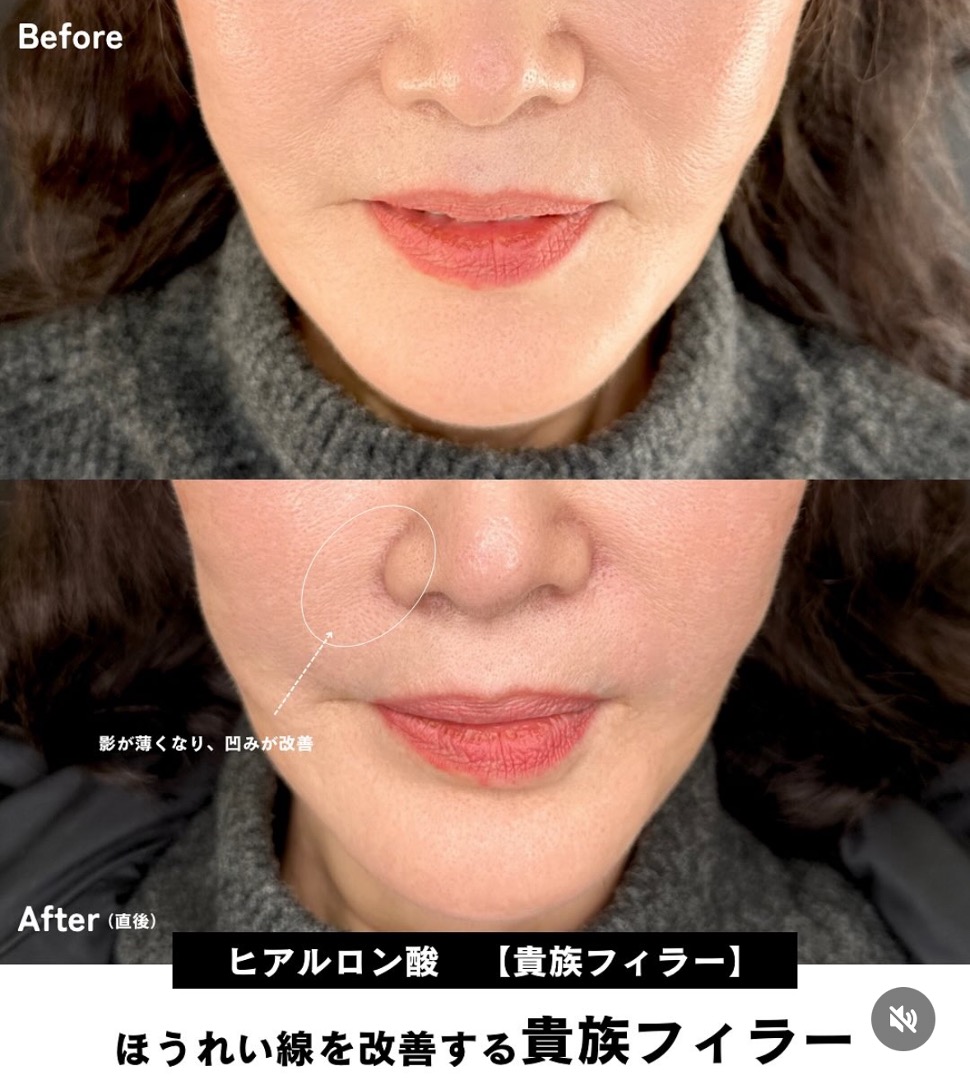 ヒアルロン酸の症例写真