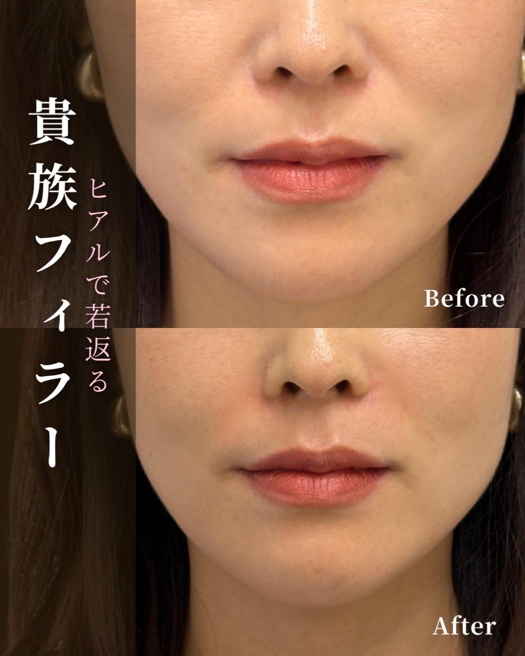 ヒアルロン酸の症例写真