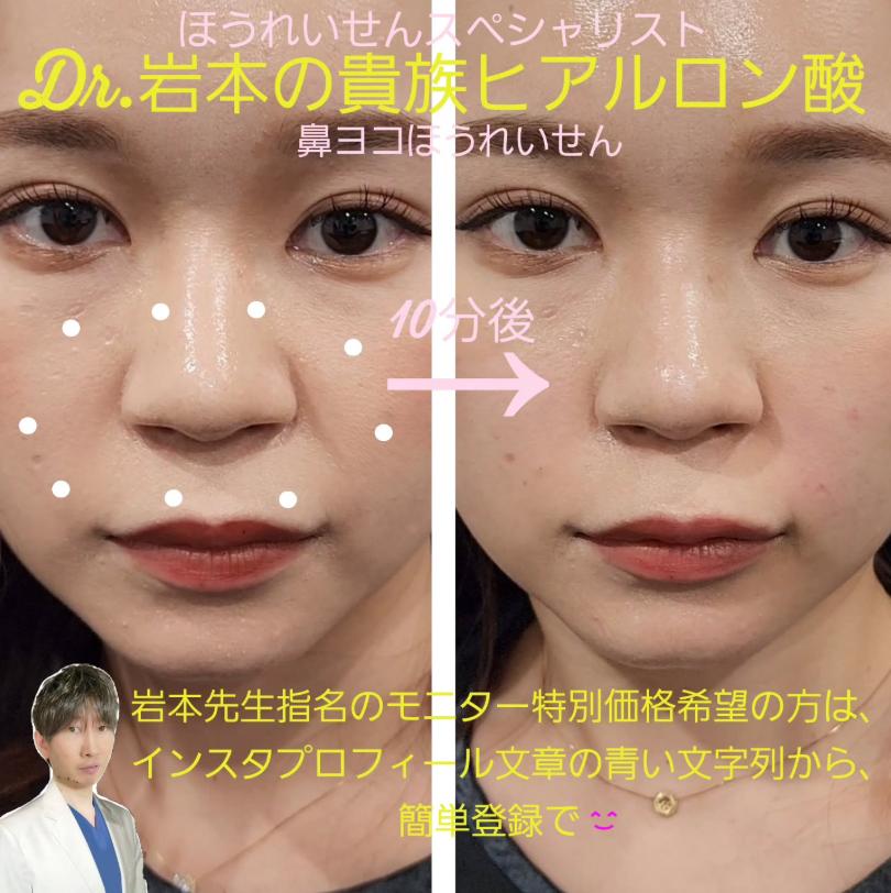 ヒアルロン酸の症例写真