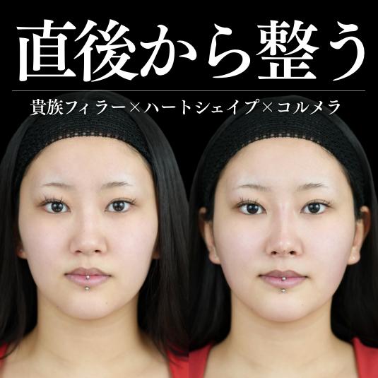 ヒアルロン酸の症例写真