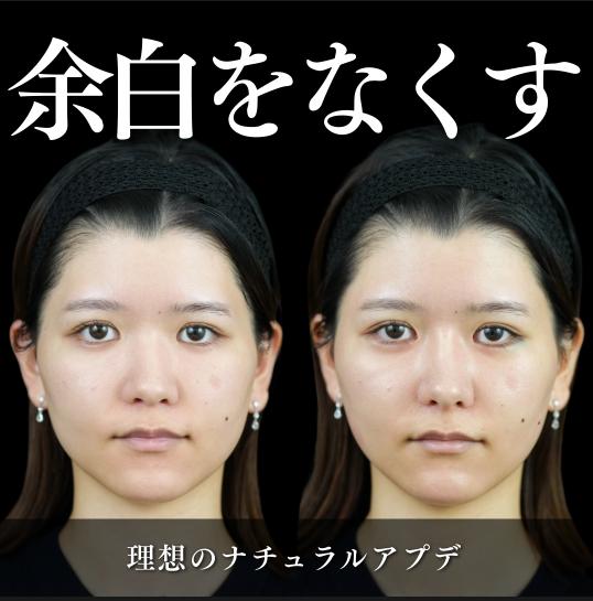 ヒアルロン酸の症例写真