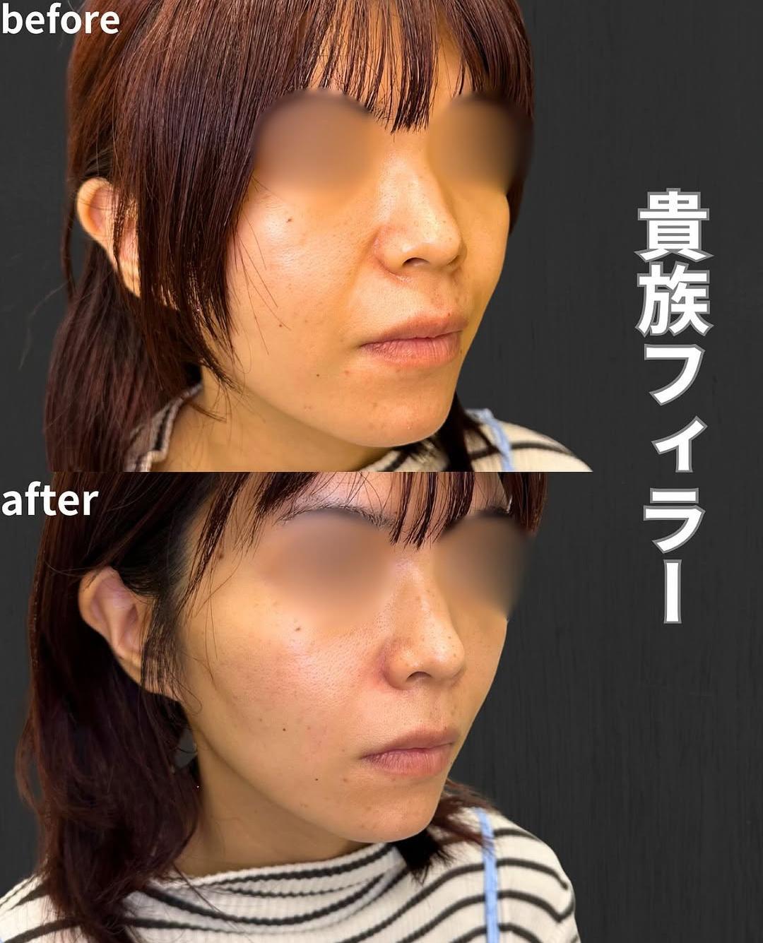 ヒアルロン酸の症例写真