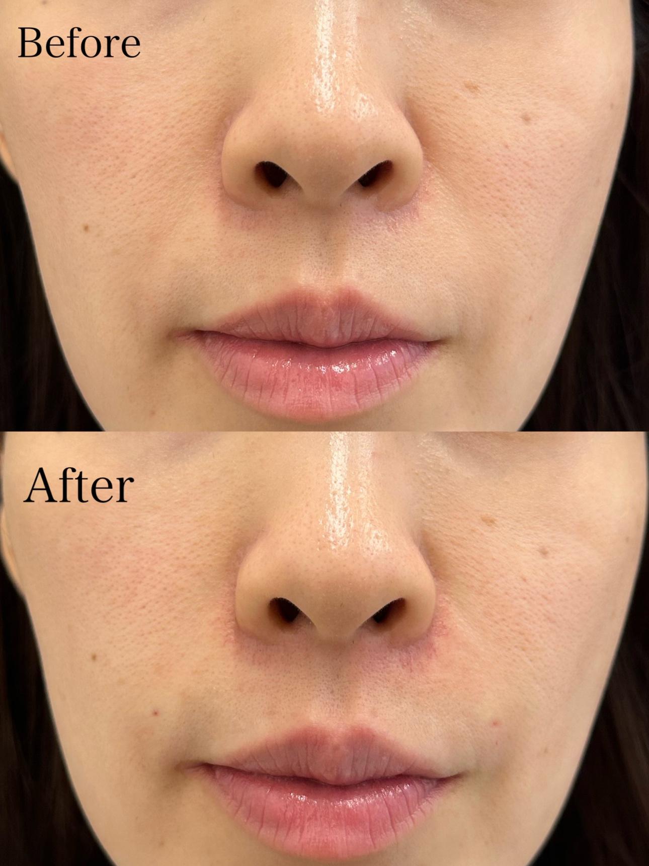 ヒアルロン酸の症例写真